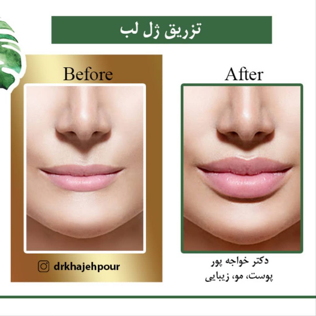 مخالف یا موافق تزریق ژل لب؟ جوانسازی پوست اصفهان مخالف یا موافق تزریق ژل لب؟ جوانسازی پوست اصفهان