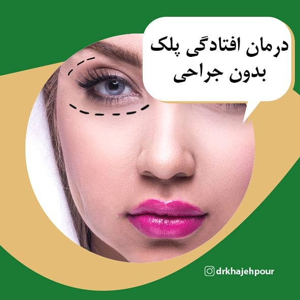 درمان افتادگی پلک اصفهان
