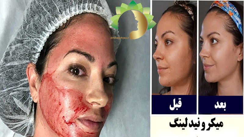 جوانسازی-پوست-در-اصفهان | دکتر-نیلوفر-خواجه-پور